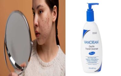 Is Vanicream Good For Acne? Best Recommendations For Your Skin