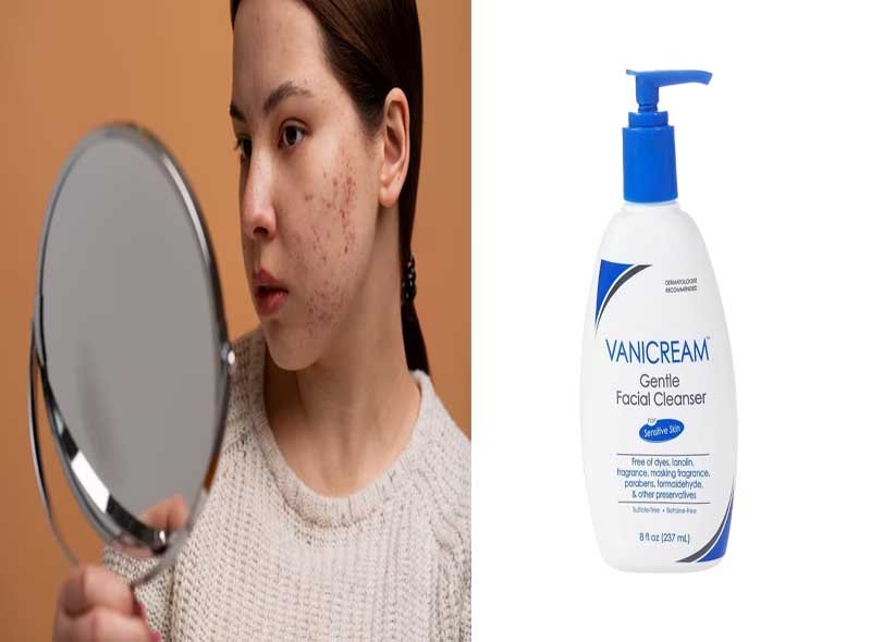 is vanicream good for acne